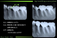 歯の神経治療のレントゲン写真