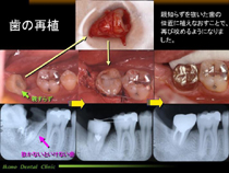 歯の再植